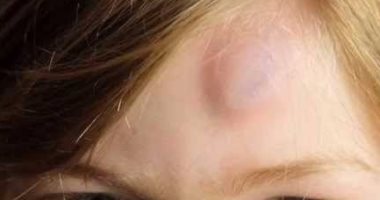 3 أسباب وراء تكوين الأكياس الدهنية.. ضمنها العامل الوراثى