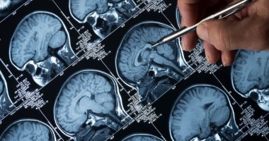 FDA  تحدد مصير أول دواء لإبطاء مرض الزهايمر يونيو المقبل