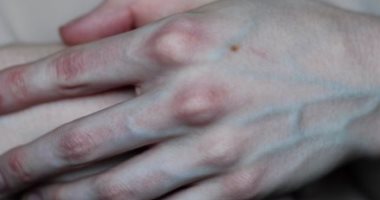 تعرف على سبب ظهور الأوردة باللون الأخضر تحت الجلد