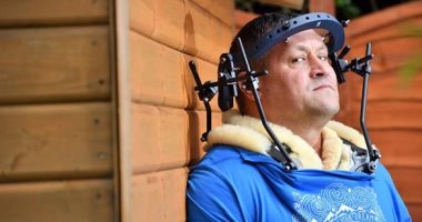 كابوس مطلق.. بريطانى يعيش مع حلقة معدنية مثبتة بجمجمته بعد تعرضه لحادث