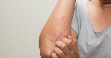 نقص التهوية من أبرز أسباب حكة الجلد والبقع الحمراء.. اعرف طرق العلاج