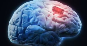 7 معلومات عن التجارب السريرية على البشر لشريحة دماغ إيلون ماسك