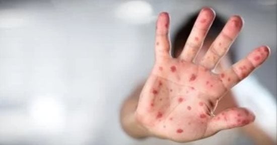 أوبئة عادت لتهدد العالم فى 2024.. فيديوجراف