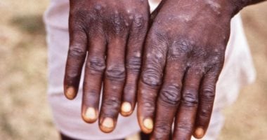 الكونغو الديمقراطية: تطعيم أكثر من 55 ألف شخص ضد جدرى القردة وتراجع الإصابات