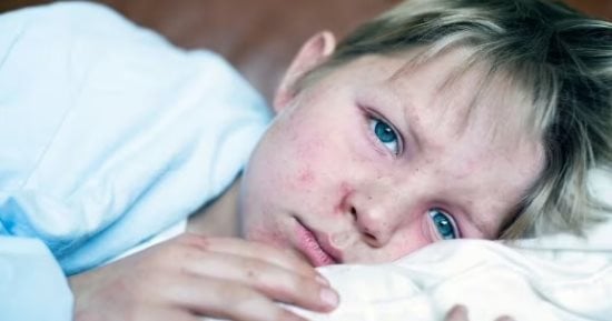 حماية طفلك من تفشي مرض الحصبة.. الأسئلة الشائعة