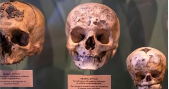 دراسة تكشف: مرض الزهري نشأ في الأمريكيتين والاستعمار الأوروبي سبب الانتشار