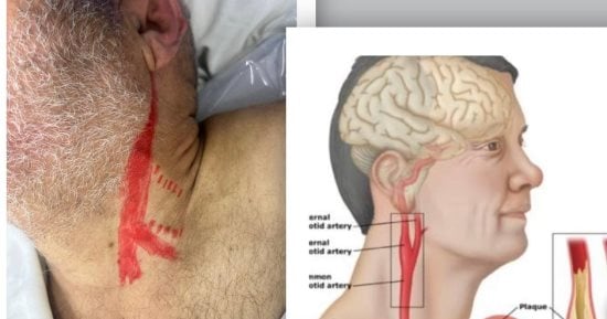 فريق طبى بمستشفى السنبلاوين فى الدقهلية ينقذ مريضا من جلطة بالمخ